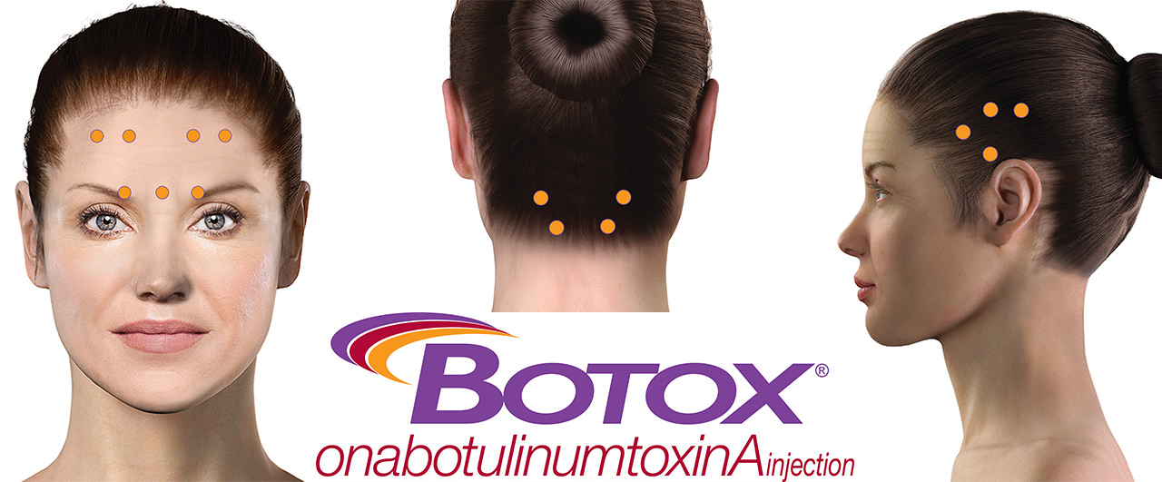 Aplicação de botox para enxaqueca
