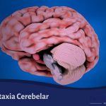 Ataxia Cerebelar
