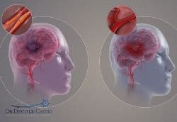 Acidente Vascular Cerebral (AVC)