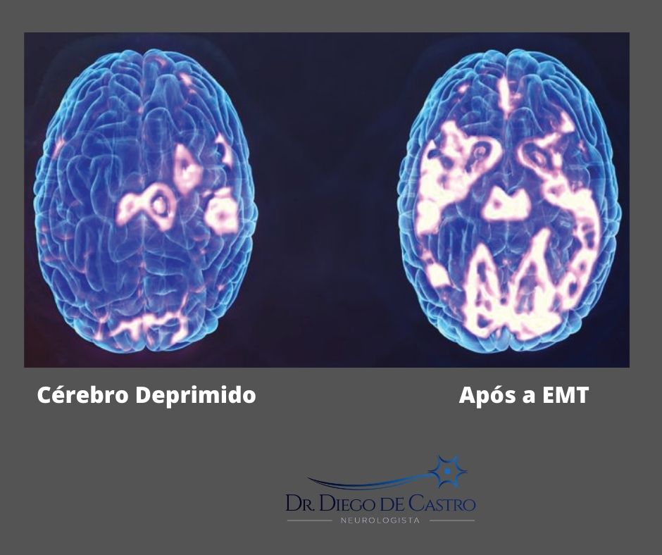 Estimulação Magnética Transcraniana