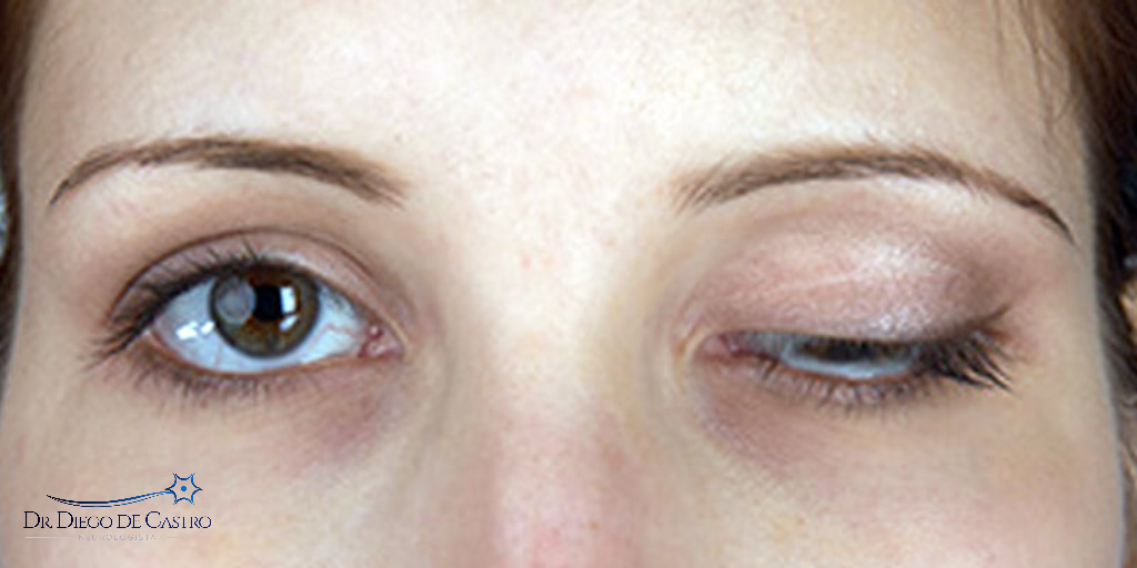 miastenia gravis ocular
