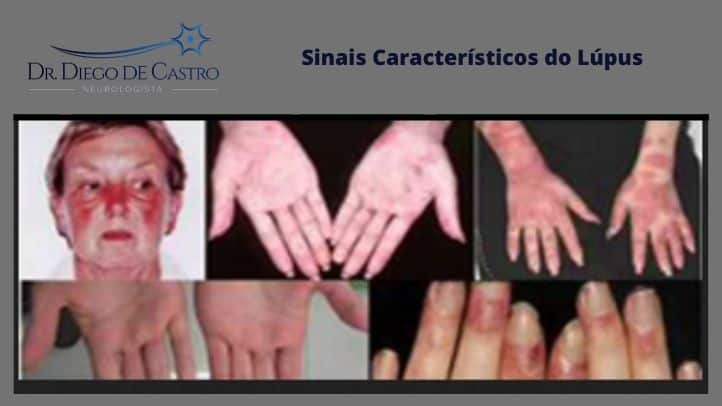 Sintomas do Lúpus Sintomas do Lupus