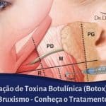 Botox para Bruxismo