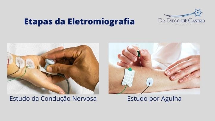 Etapas da Eletromiografia
