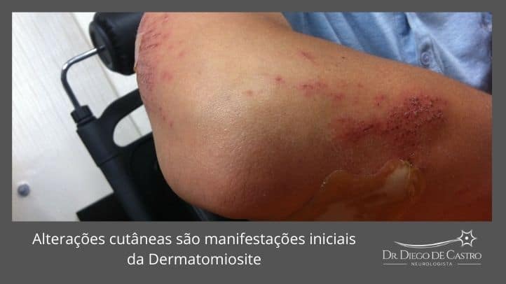 Dermatomiosite 