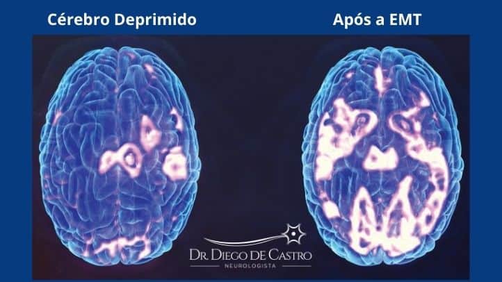 EMT no cérebro deprimido