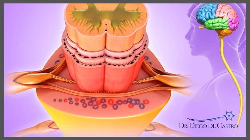 Mielite transversa