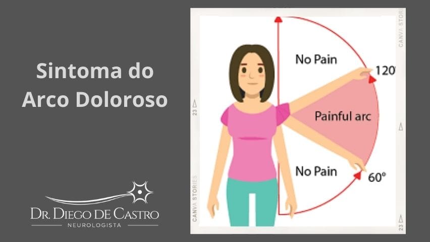 Sintoma do Arco Doloroso