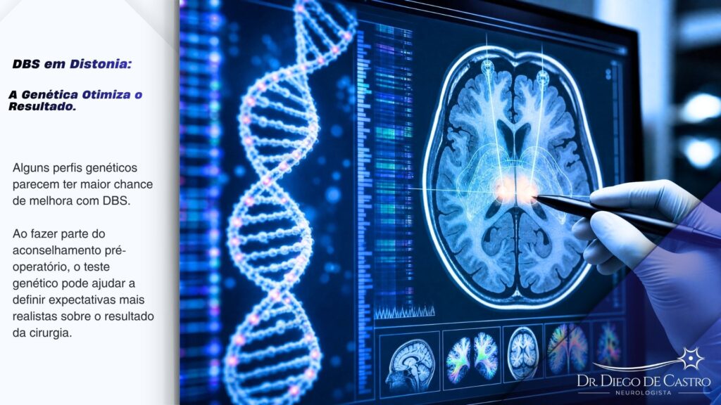 Ilustração médica detalhada mostrando uma tela de computador com uma sequência de DNA e uma imagem de ressonância magnética cerebral destacando a área do globo pálido interno, com uma mão enluvada apontando para a tela, simbolizando a análise genética e a personalização do tratamento de DBS para distonia.