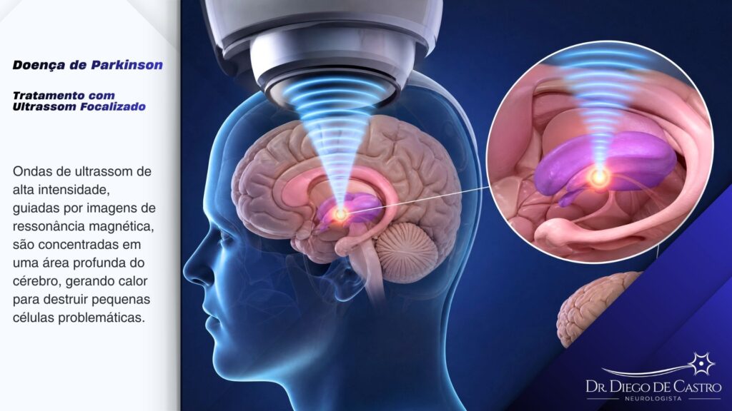 Tratamento com Ultrassom Focalizado Tratamento com Ultrassom Focalizado