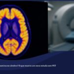 Representação estilizada de um exame de PET cerebral em corte axial, com a região central profunda em tons frios de azul e roxo contrastando com áreas em tons quentes, ilustrando sinal reduzido de um marcador dopaminérgico na covid longa.