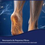 Ilustração médica de fibras nervosas finas luminosas percorrendo pernas e pés, representando a neuropatia de pequenas fibras.
