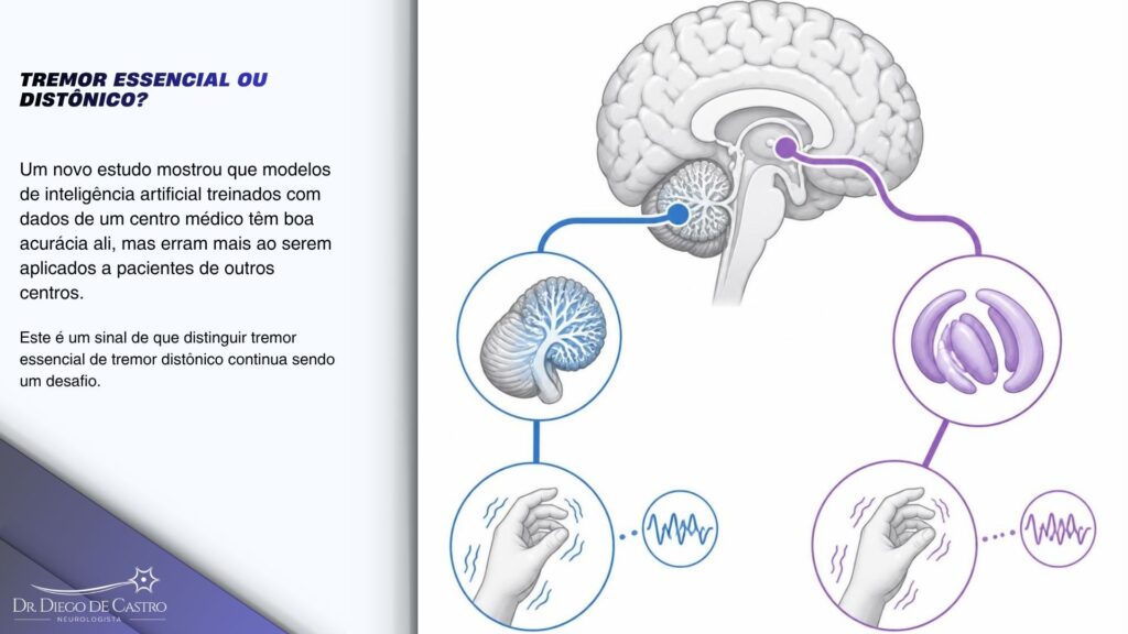 Diagrama de um cérebro mostrando duas vias neurológicas diferentes associadas ao tremor essencial e ao tremor distônico. Diagrama de um cérebro mostrando duas vias neurológicas diferentes associadas ao tremor essencial e ao tremor distônico.