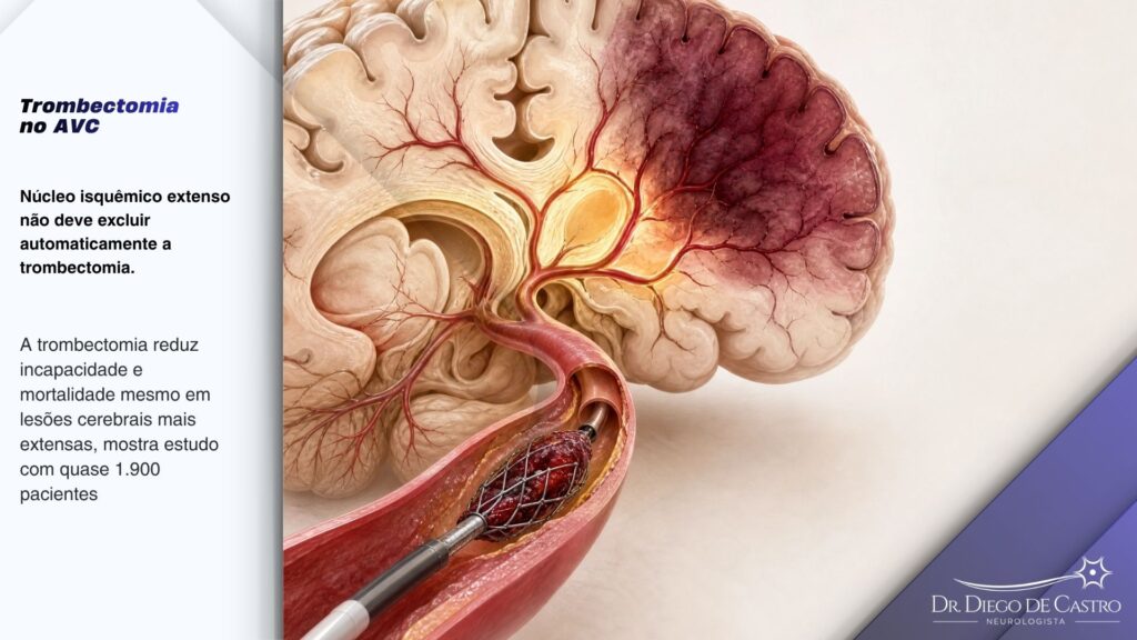 Como funciona a trombectomia no AVC com núcleo isquêmico extenso — Dr. Diego de Castro Ilustração anatômica do cérebro com núcleo isquêmico extenso e cateter realizando trombectomia mecânica