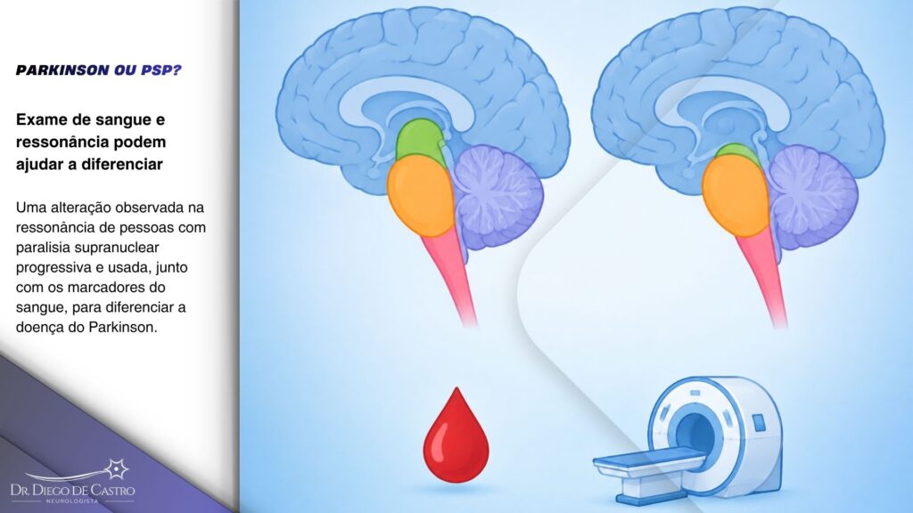 Ilustração esquemática que ajuda a diferenciar Parkinson de PSP: dois troncos cerebrais, um deles com o mesencéfalo reduzido em relação à ponte, ao lado de ícones de gota de sangue e de ressonância magnética. Ilustração esquemática que ajuda a diferenciar Parkinson de PSP: dois troncos cerebrais, um deles com o mesencéfalo reduzido em relação à ponte, ao lado de ícones de gota de sangue e de ressonância magnética.