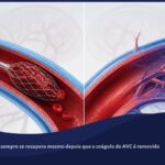 Ilustração de artéria cerebral sendo desobstruída por trombectomia, com capilares menores ainda bloqueados por microcoágulos, representando o fenômeno de no-reflow após AVC.