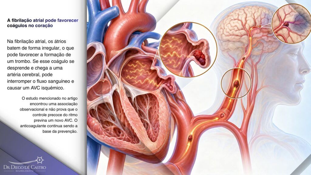 Fibrilação atrial e risco de AVC isquêmico | Dr. Diego de Castro Ilustração anatômica de um coágulo no átrio esquerdo seguindo por uma artéria até um vaso cerebral.