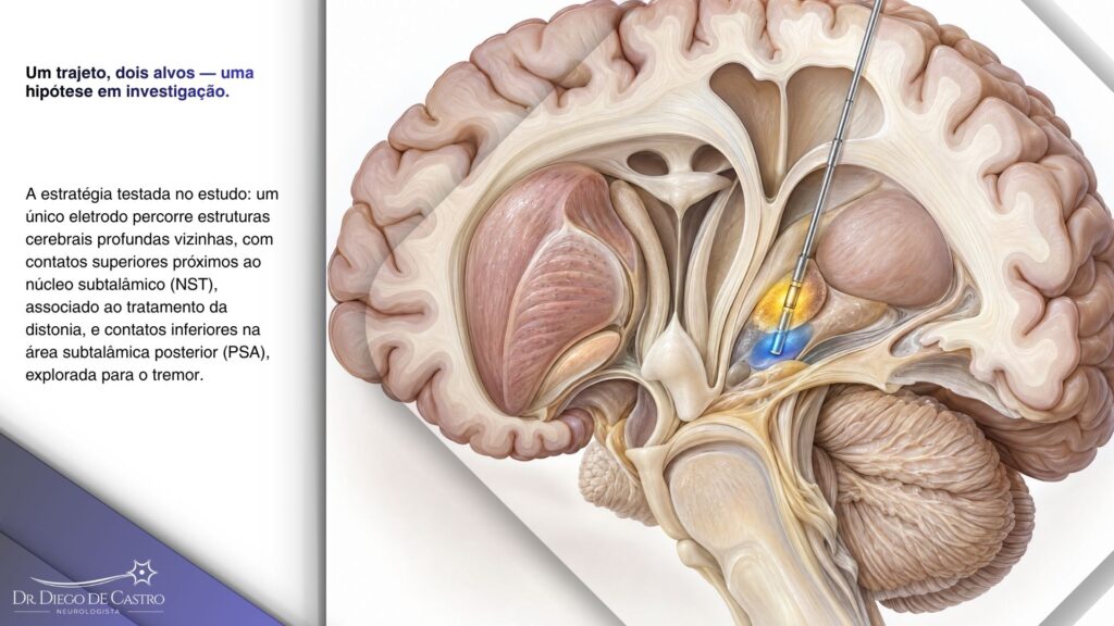 Trajeto único de eletrodo entre NST e PSA | Dr. Diego de Castro Ilustração anatômica de um único eletrodo que percorre as proximidades do núcleo subtalâmico e da área subtalâmica posterior.